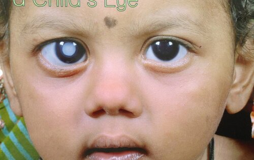 Symbolbild „Through a Child’s Eye“ – Aufklärung über Grauen Star (Katarakt) im Kindesalter