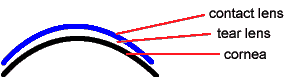 Schematische Darstellung einer Kontaktlinse auf dem Auge mit Hornhaut, Tränenlinse und Linse