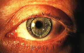 Auge mit formstabiler Kontaktlinse – Darstellung einer harten Linse zur Korrektur von Fehlsichtigkeiten