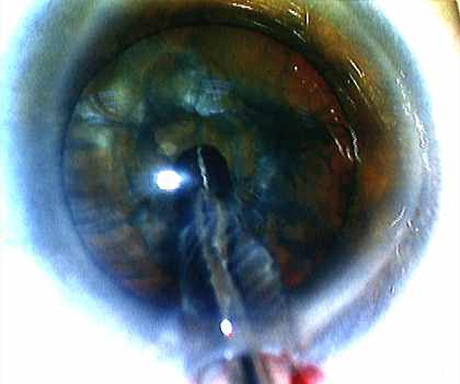 phakoemulsifikation