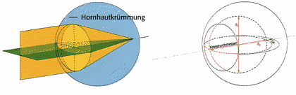 hornhautverkrümmung